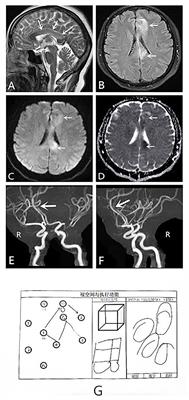 Case Report: 
Good Prognosis of Mixed Alien Hand Syndrome by Verbal-Cue Rehabilitation Exercise